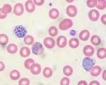 Malaria in peripheral blood.Image: Ed Uthman/Flickr/CC-BY-2.0.