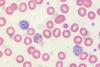 Malaria in peripheral blood.Image: Ed Uthman/Flickr/CC-BY-2.0.