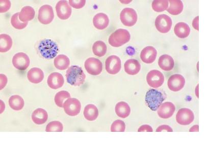 Malaria in peripheral blood.Image: Ed Uthman/Flickr/CC-BY-2.0.